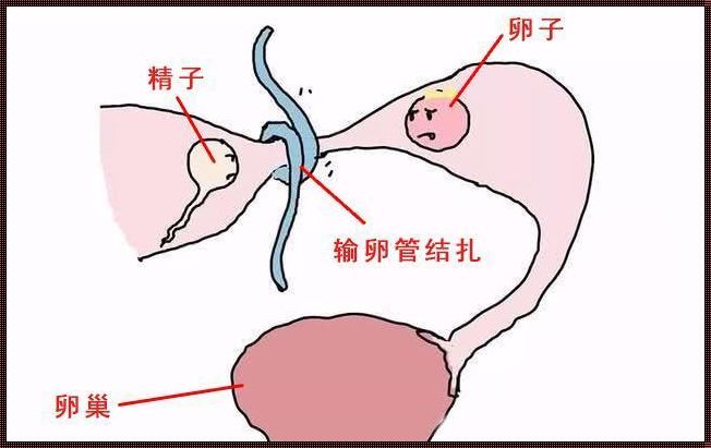 剖腹产结扎复通怀孕几率大吗？一位母亲的真挚分享