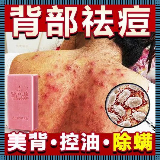 背后痘痘去除秘籍：探索自然疗法与生活调整