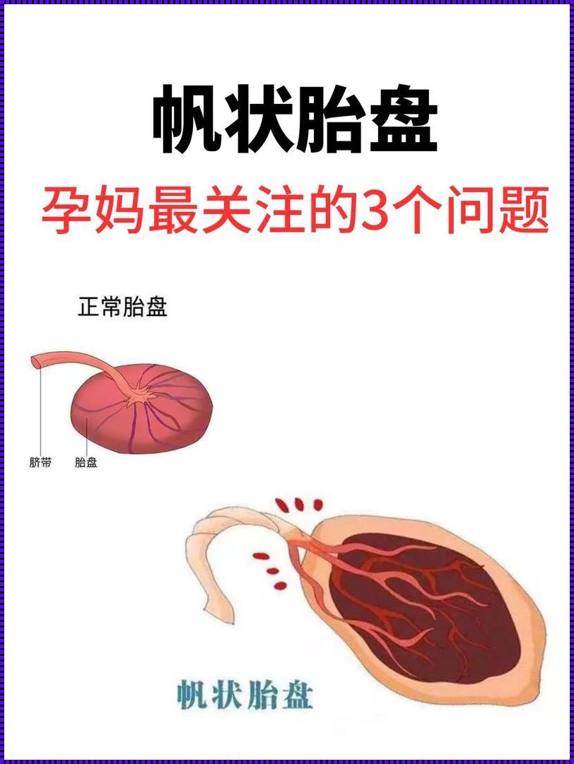 慢高怀孕会出现帆状胎盘吗？——一场生命旅途的探究