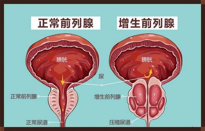 前列腺增大伴结石怎么办？探秘男性健康的隐秘困扰