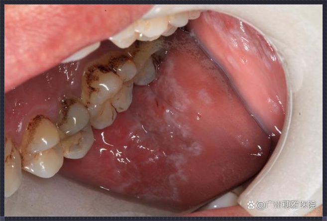 口腔白斑能擦掉是什么病