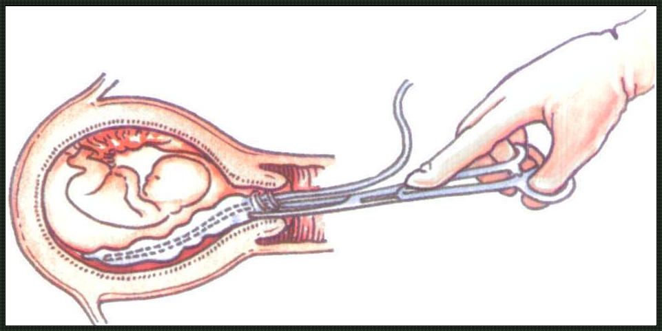 17周引产过程痛苦吗：探讨引产的苦与乐
