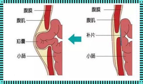 小儿疝气是怎么造成的：揭秘