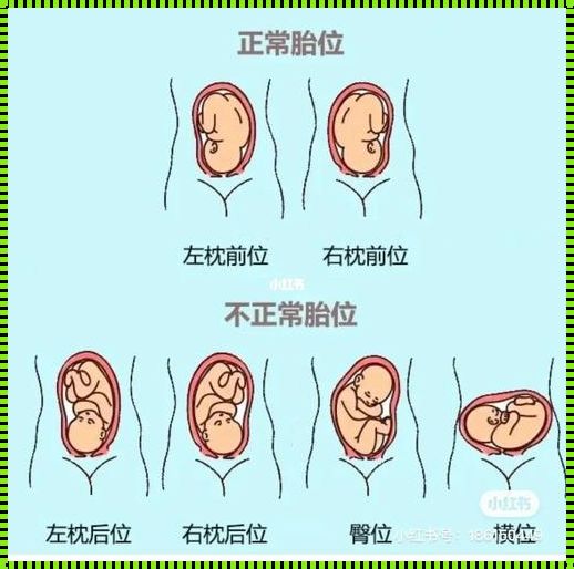 胎儿横位迷信说法：破解误区，守护健康