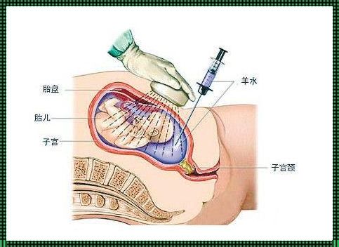 为什么羊水穿刺好多人不准确