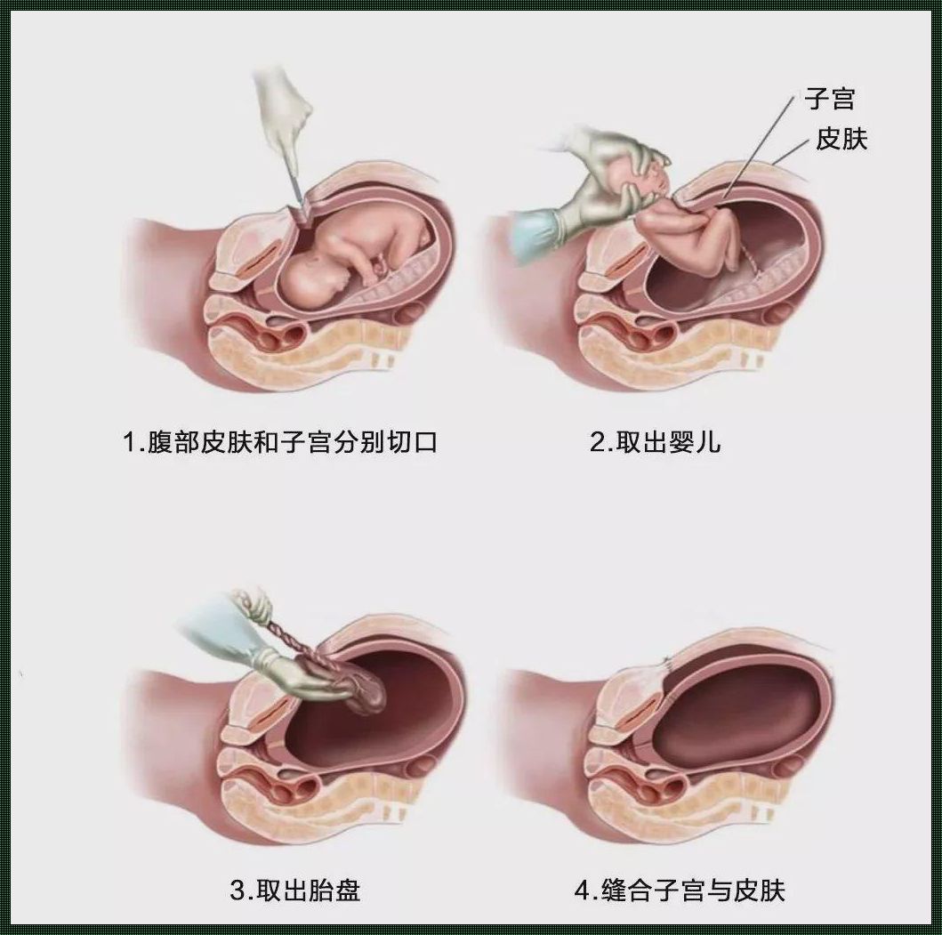 剖腹产过程详细图解：风云再起