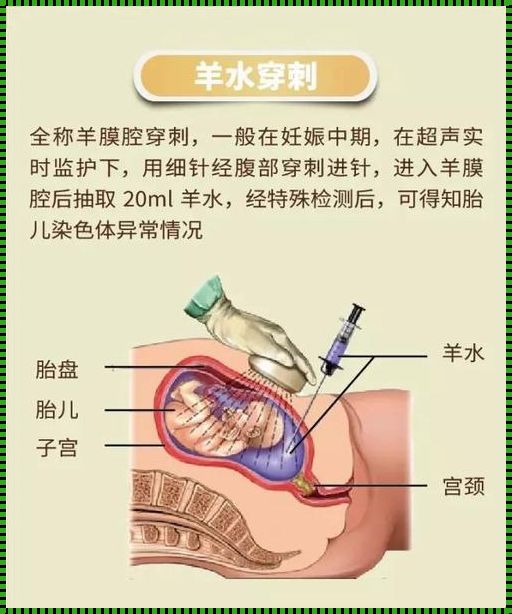 孕晚期羊水穿刺风险：揭开神秘面纱