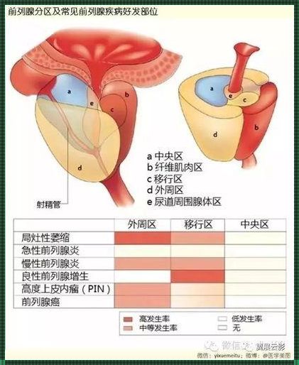 前列腺移行区有结节说明什么