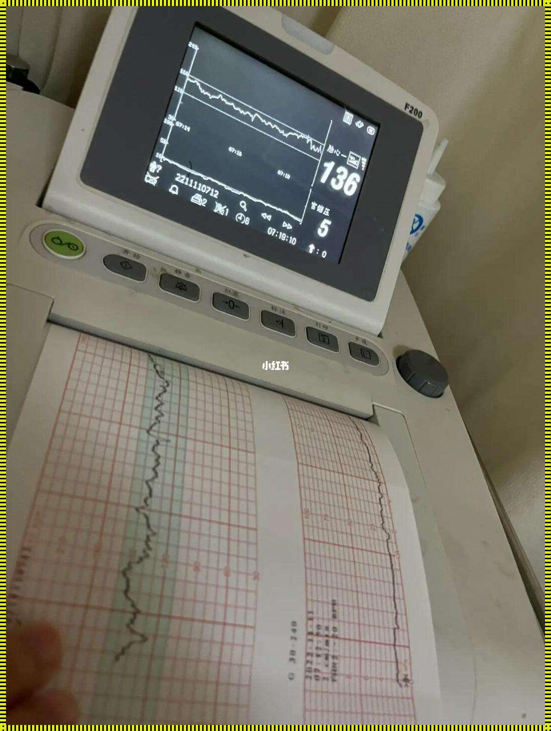 35周胎心监护不过要紧吗？深入解析与您分享