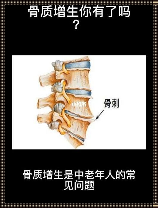 什么样的人容易长骨刺