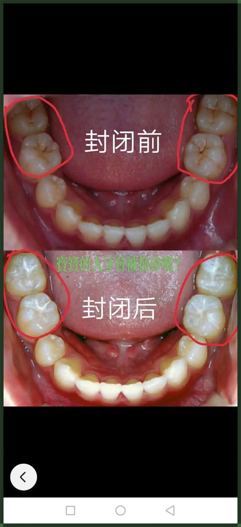 哪几颗牙齿不会换：揭秘人类牙齿更换的奥秘