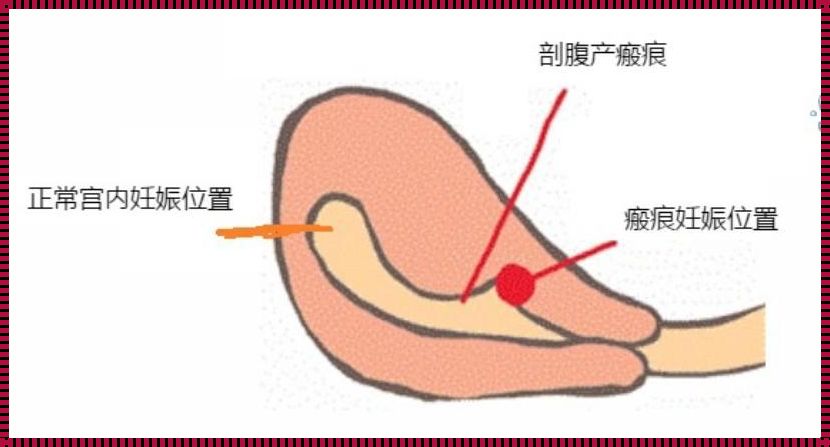 为什么胎儿会着床疤痕处