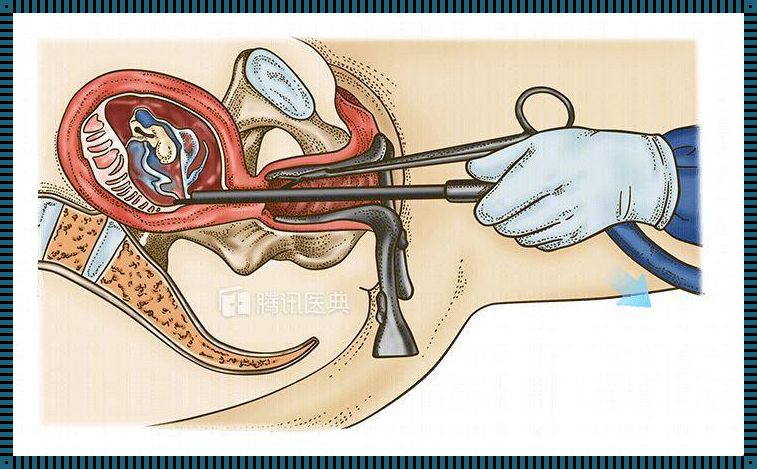 怀孕13周可以做无痛人流手术