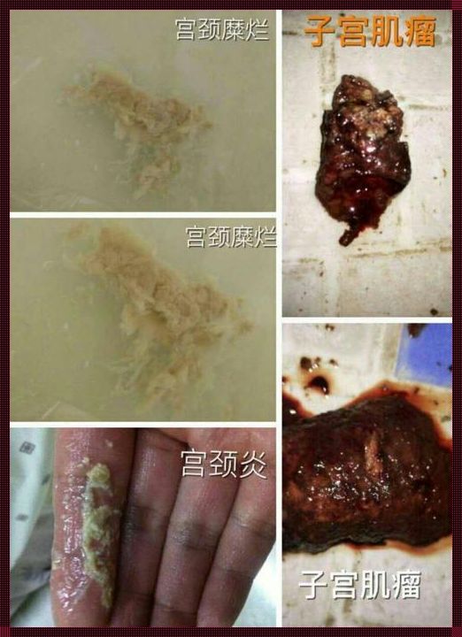 植物耀素用完排出的是什么