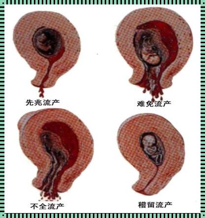 怀孕11周最佳流产方式：理性与关爱的交织