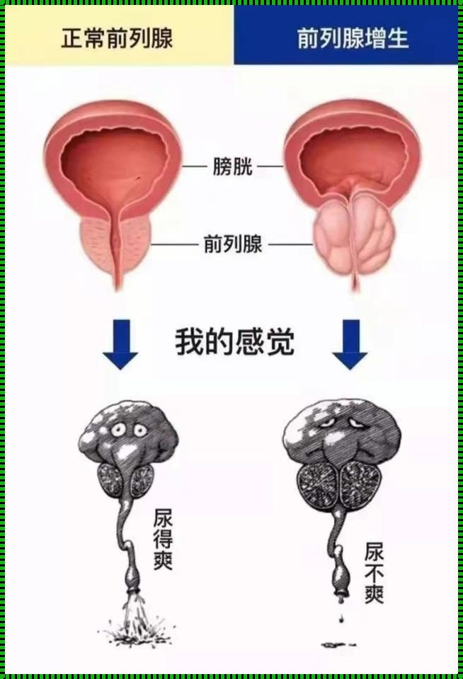 前列腺增生会缩小吗？揭秘前列腺增生的治疗与恢复