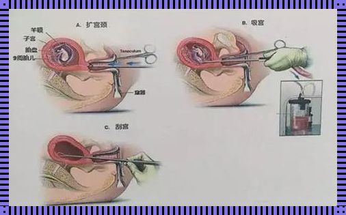 怀孕多久适合流产手术