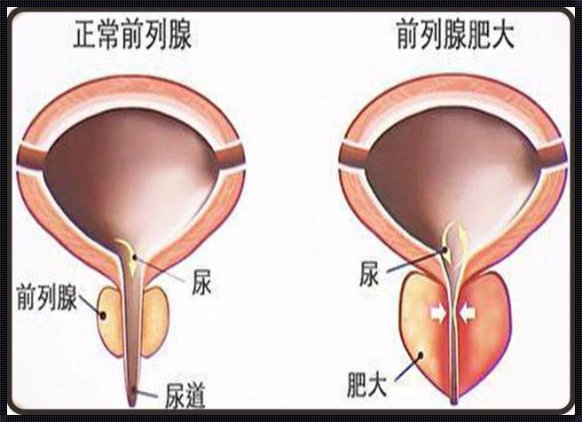 前列腺偏大：探秘男人“秘密”地带