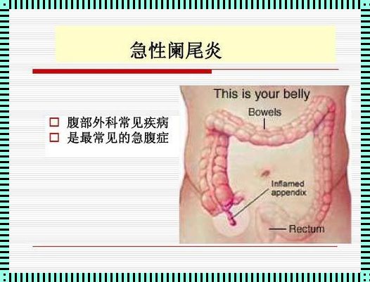 阑尾炎与月经：一场不期而至的困扰