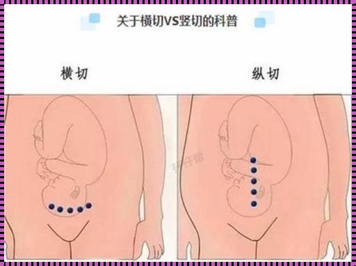 双胎为什么大都36周剖腹：揭开早产背后的故事