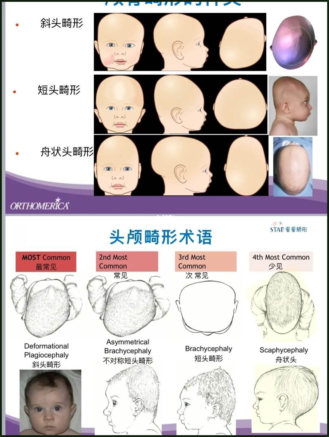 34周双顶径76毫米，真的是小头畸形吗？