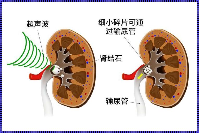 体外碎石到底疼不疼