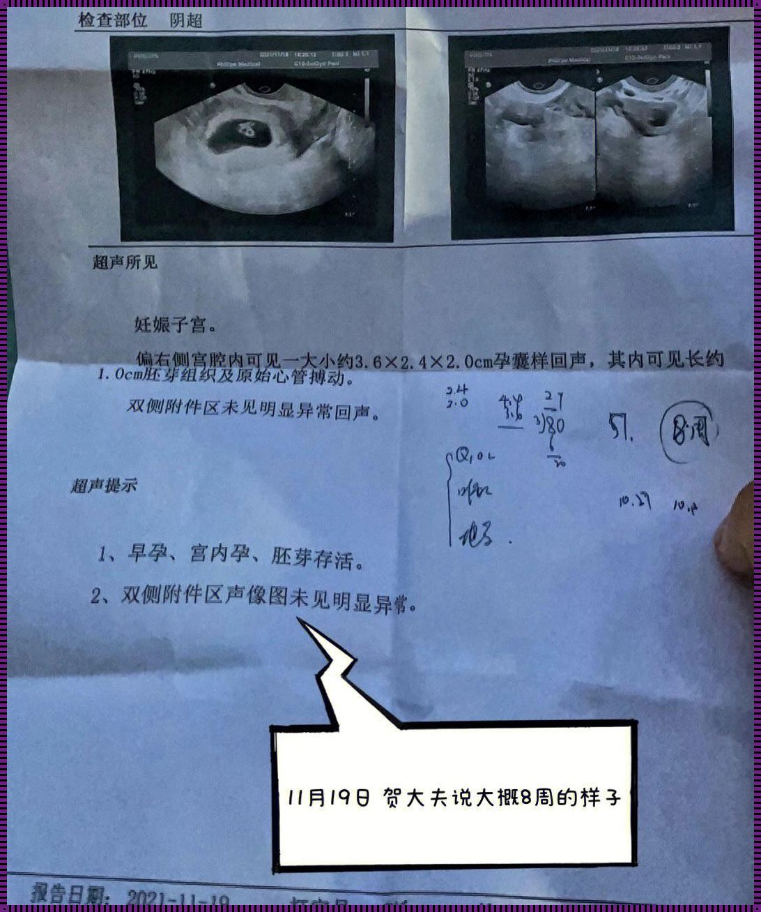 多次生化妊娠后，女性如何实现健康怀孕的希望之路