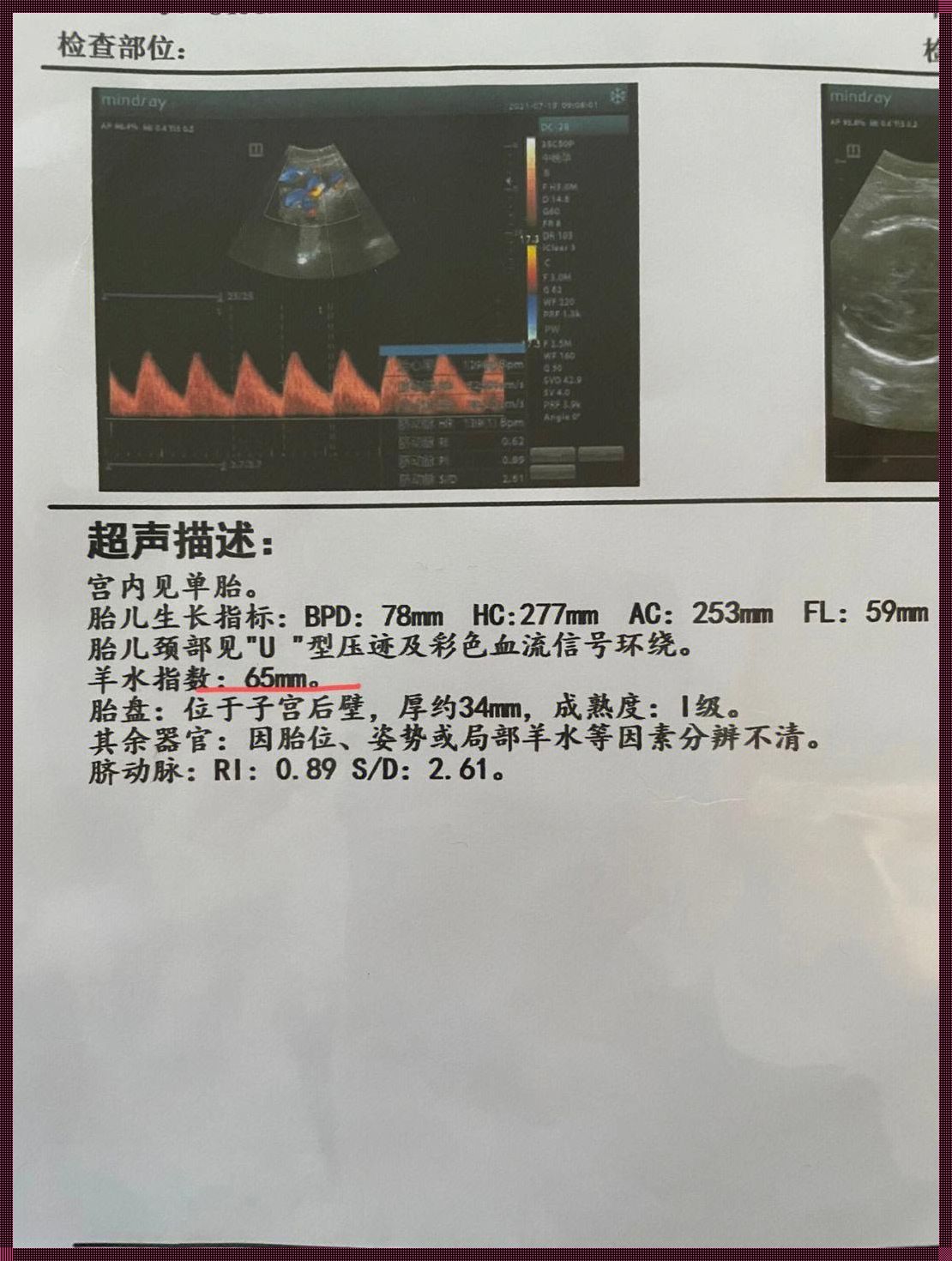 三十七周羊水少，母爱如海涌