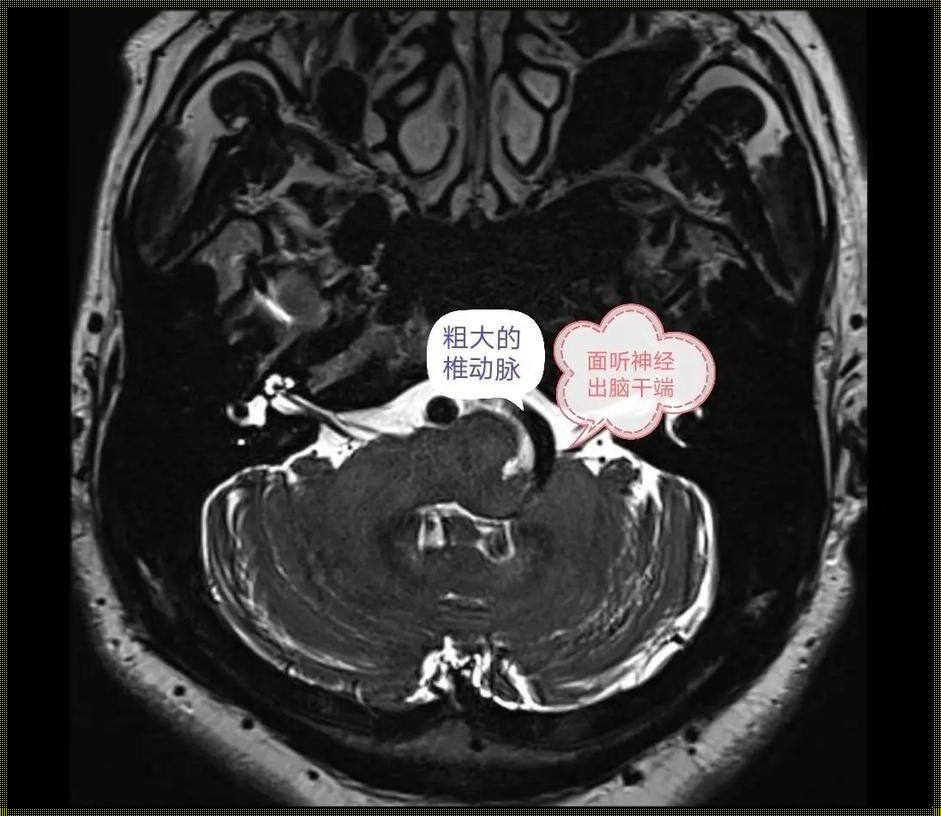 面部神经抖动：美容视角下的健康启示