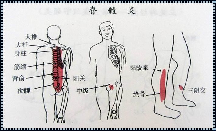 脊髓炎：母婴健康守护的挑战与希望