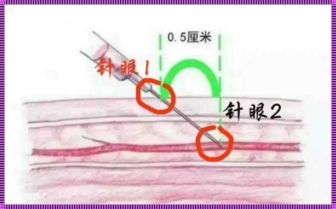 卡介苗进针角度：守护生命之针的精准艺术