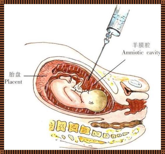 孕28周可以引产吗：生命之重与选择之难