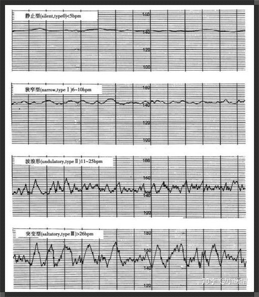 怀孕心电图诊断突心律：守护母婴安全的隐形防线
