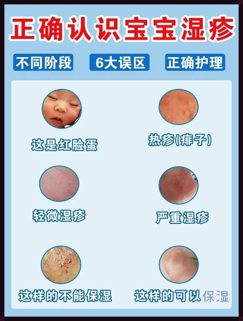 宝宝出湿疹了怎么办小妙招