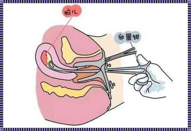 揭秘：刮宫与人工流产的区别