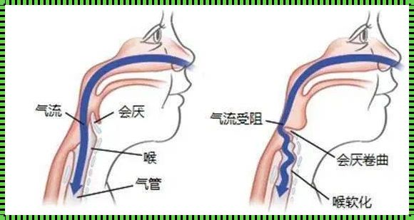 婴儿喉软骨软化：探秘宝宝喉咙的秘密