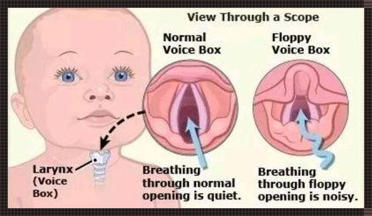 婴儿喉软骨软化：探秘宝宝喉咙的秘密