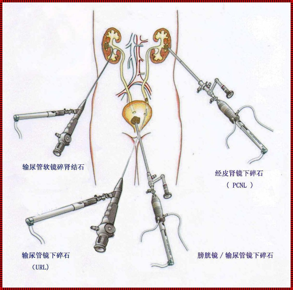 【探秘】泌尿结石手术后，何时能重获自由?