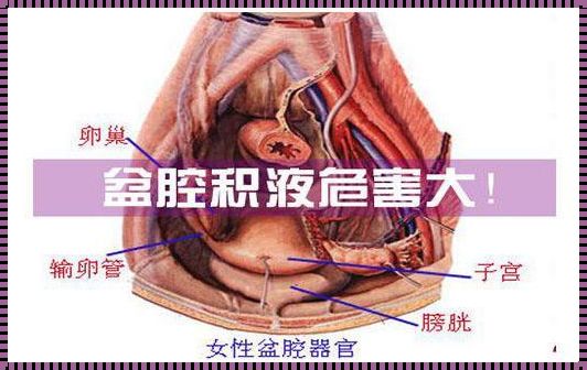 产后惊现子宫直肠窝积液9mm，这事儿真严重吗？