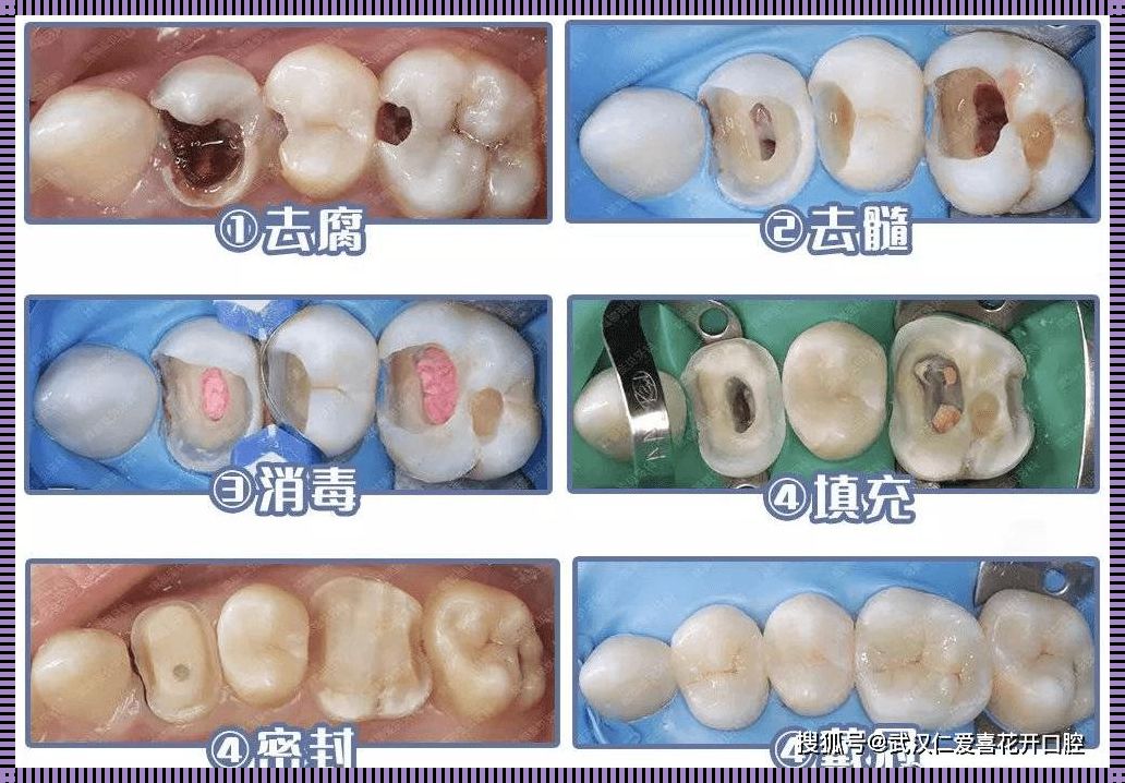 惊现产后恢复之路：当整颗牙只剩牙根，如何补牙重生？