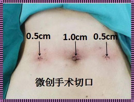 母婴社区揭秘：疝气手术后，如何看出手术是否成功？