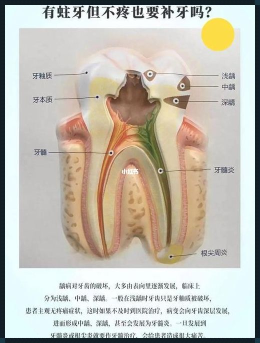 浅龋补牙：利弊之间的较量