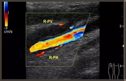 彩色多普勒超声检查：女性血管健康的榜首守护神