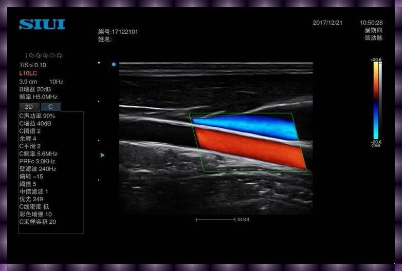 彩色多普勒超声检查：女性血管健康的榜首守护神