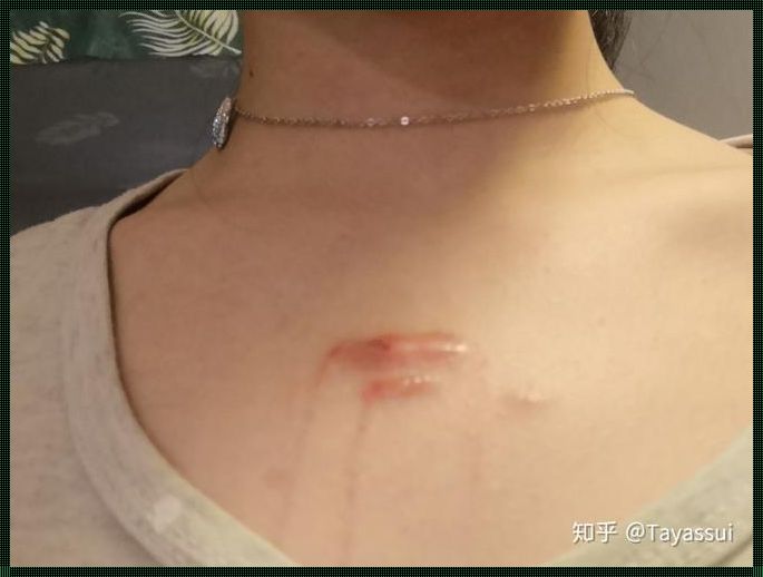 揭秘：为什么女生胸口一道疤