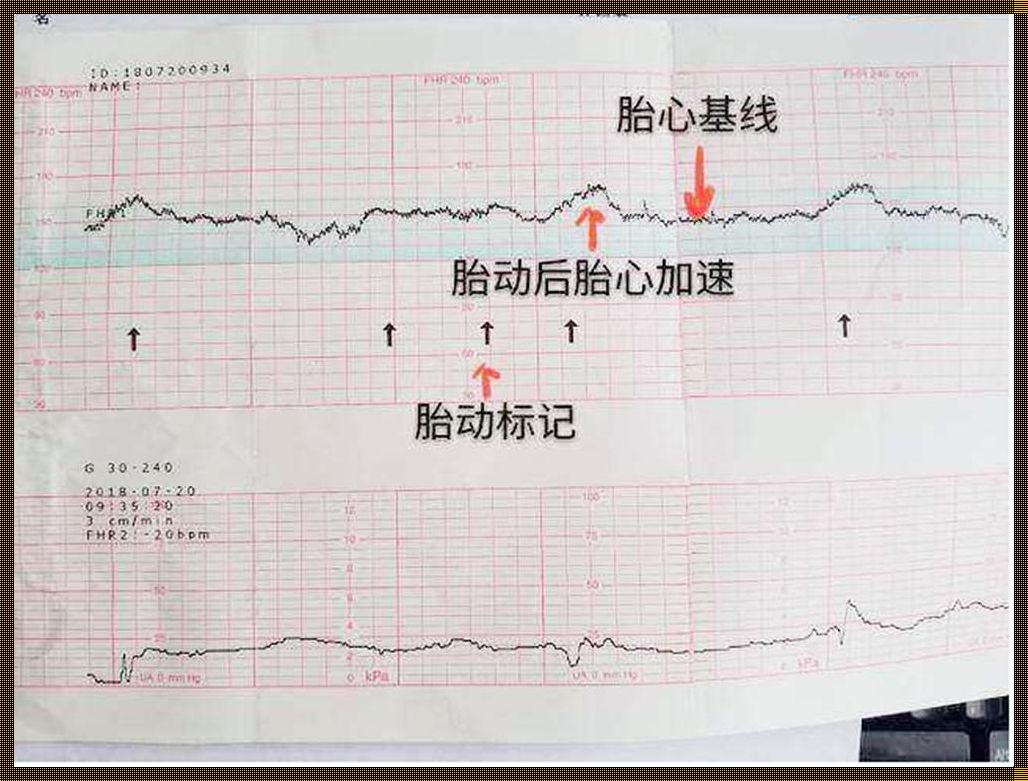 胎监一定要胎儿动才可以吗？