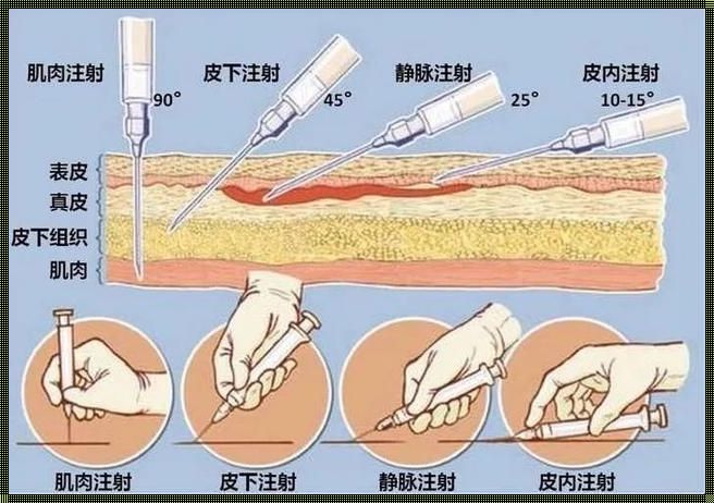 卡介苗注射部位及角度：探寻疫苗接种的奥秘