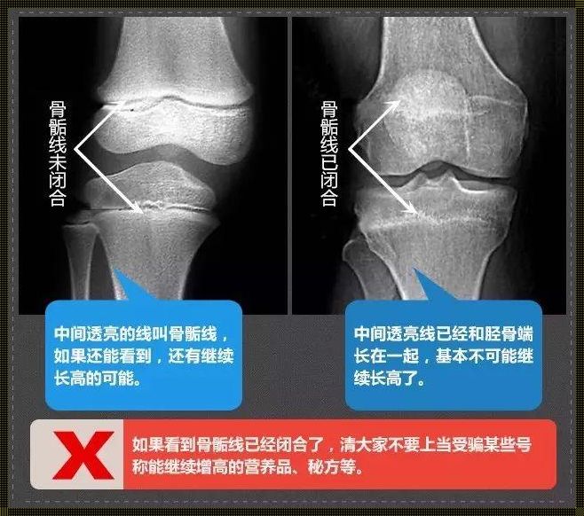 骨骺线开始融合是不是就长不高了