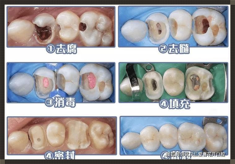 门牙医生不建议做根管治疗：一篇深入探讨的背后原因