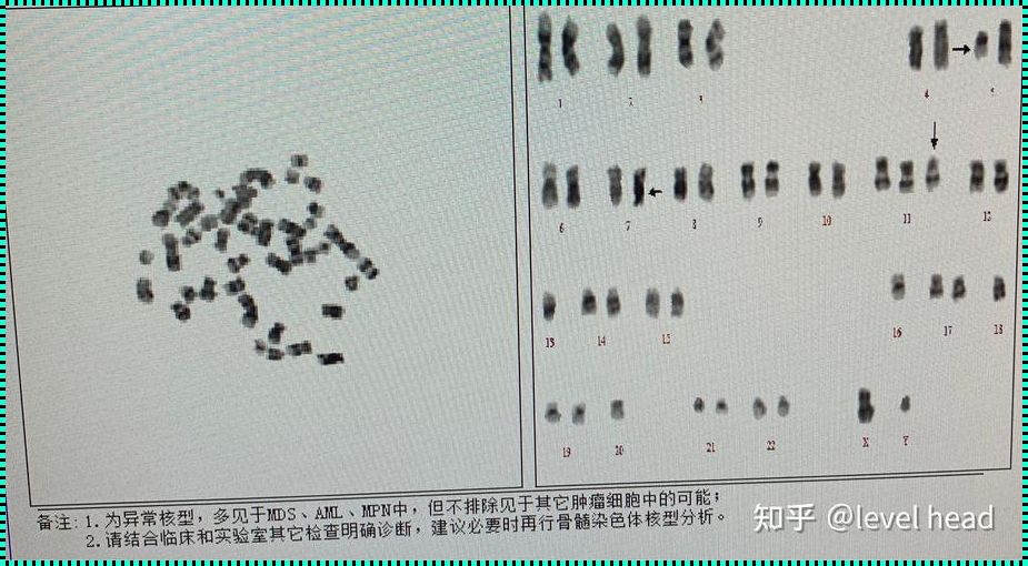 FISH与核型：遗传学诊断的双剑合璧